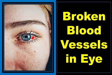hot or cold compress for broken blood vessel in eye|Blood in Eye: Causes, Healing, and When to Worry .